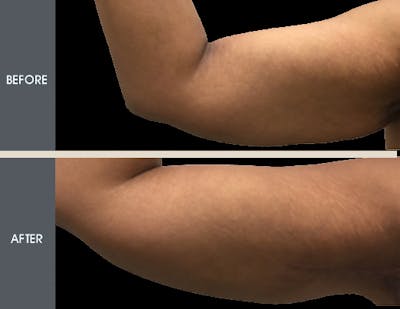 Arm Lift (Brachioplasty) Before & After Gallery - Patient 2207263 - Image 1