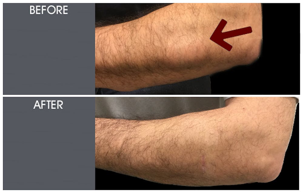 Lipoma Removal Gallery Before & After Gallery - Patient 2207277 - Image 1