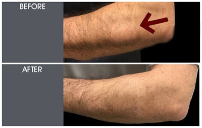 Lipoma Removal Before & After Gallery - Patient 2207277 - Image 1