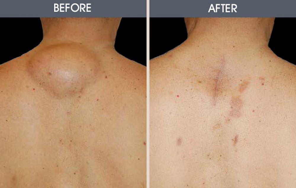 Lipoma Removal Gallery Before & After Gallery - Patient 2207294 - Image 1