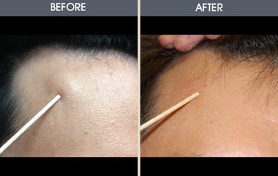 Lipoma Removal Before & After Gallery - Patient 2207311 - Image 1
