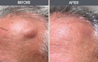 Lipoma Removal Before & After Gallery - Patient 2207324 - Image 1