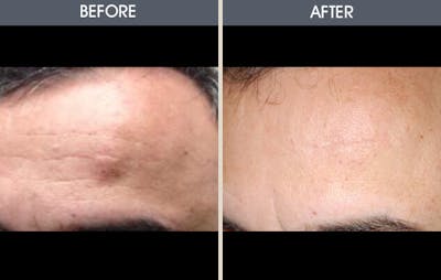 Lipoma Removal Gallery Before & After Gallery - Patient 2207338 - Image 1