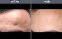 Lipoma Removal Before & After Gallery - Patient 2207338 - Image 1