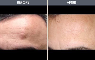 Lipoma Removal Before & After Gallery - Patient 2207338 - Image 1