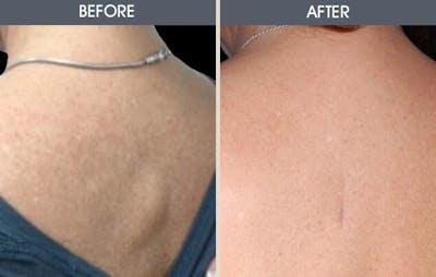 Lipoma Removal Before & After Gallery - Patient 2207369 - Image 1