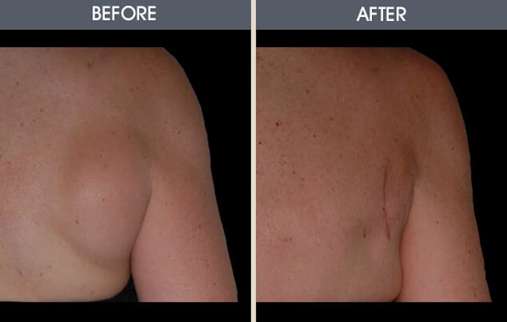 Lipoma Removal Before & After Gallery - Patient 2207392 - Image 1