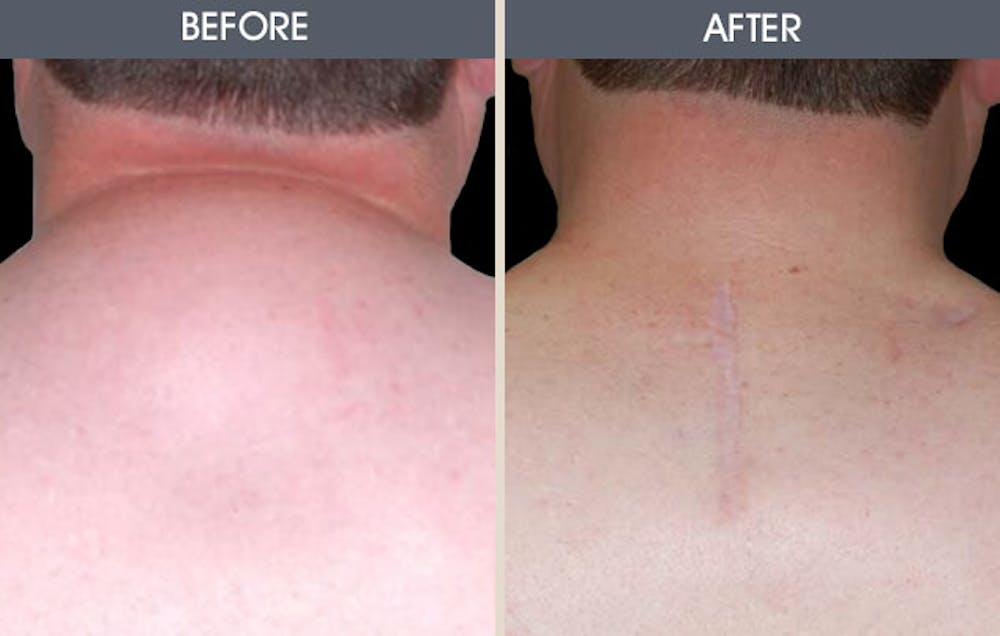 Lipoma Removal Gallery Before & After Gallery - Patient 2207403 - Image 1