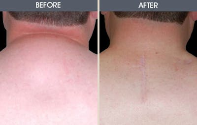 Lipoma Removal Before & After Gallery - Patient 2207403 - Image 1