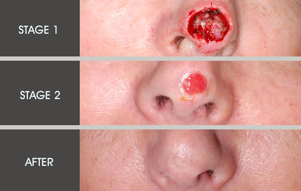 Skin Cancer Reconstruction Gallery Before & After Gallery - Patient 2207419 - Image 1