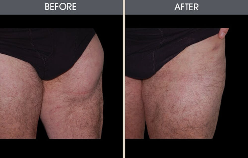 Lipoma Removal Gallery Before & After Gallery - Patient 2207422 - Image 1