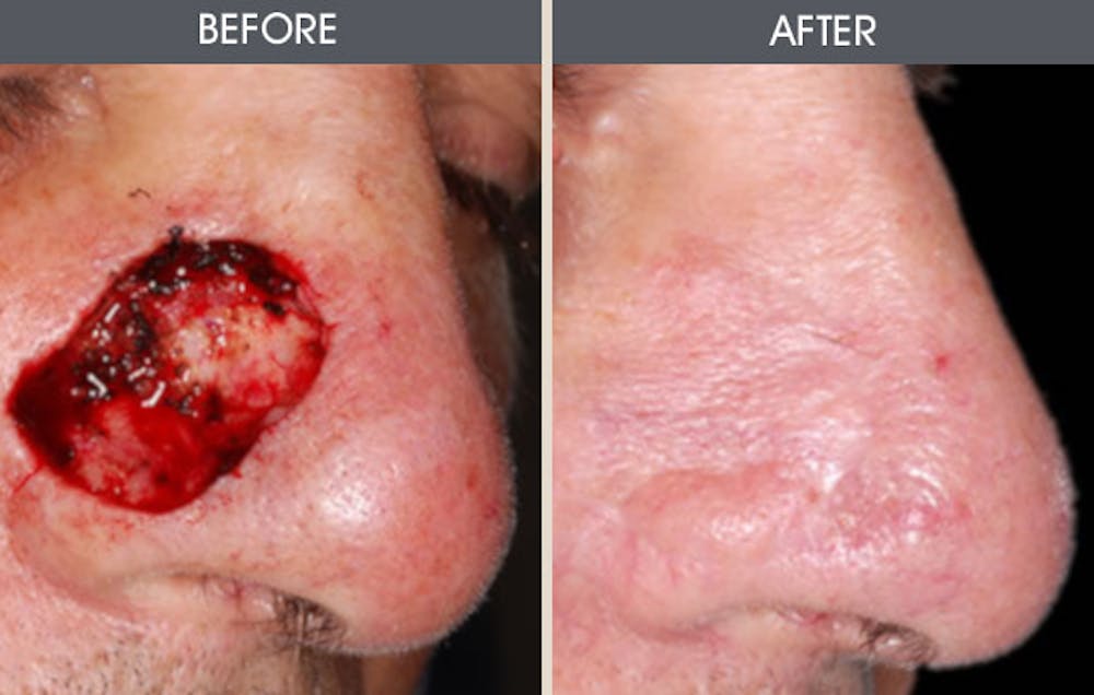 Skin Cancer Reconstruction Gallery - Patient 2207434 - Image 1