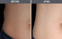 Lipoma Removal Gallery Before & After Gallery - Patient 2207435 - Image 1