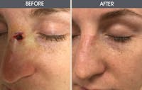 Skin Cancer Reconstruction Before & After Gallery - Patient 2207449 - Image 1