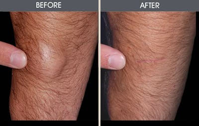 Lipoma Removal Gallery Before & After Gallery - Patient 2207457 - Image 1