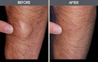 Lipoma Removal Before & After Gallery - Patient 2207457 - Image 1