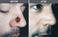 Skin Cancer Reconstruction Before & After Gallery - Patient 2207462 - Image 1