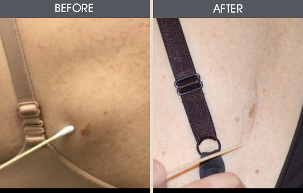 Lipoma Removal Gallery Before & After Gallery - Patient 2207463 - Image 1