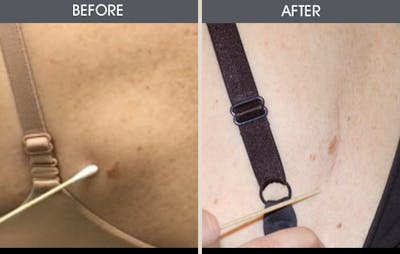 Lipoma Removal Before & After Gallery - Patient 2207463 - Image 1