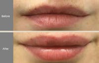 Lip Fillers Gallery Before & After Gallery - Patient 149147500 - Image 1