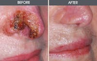 Skin Cancer Reconstruction Before & After Gallery - Patient 2207489 - Image 1