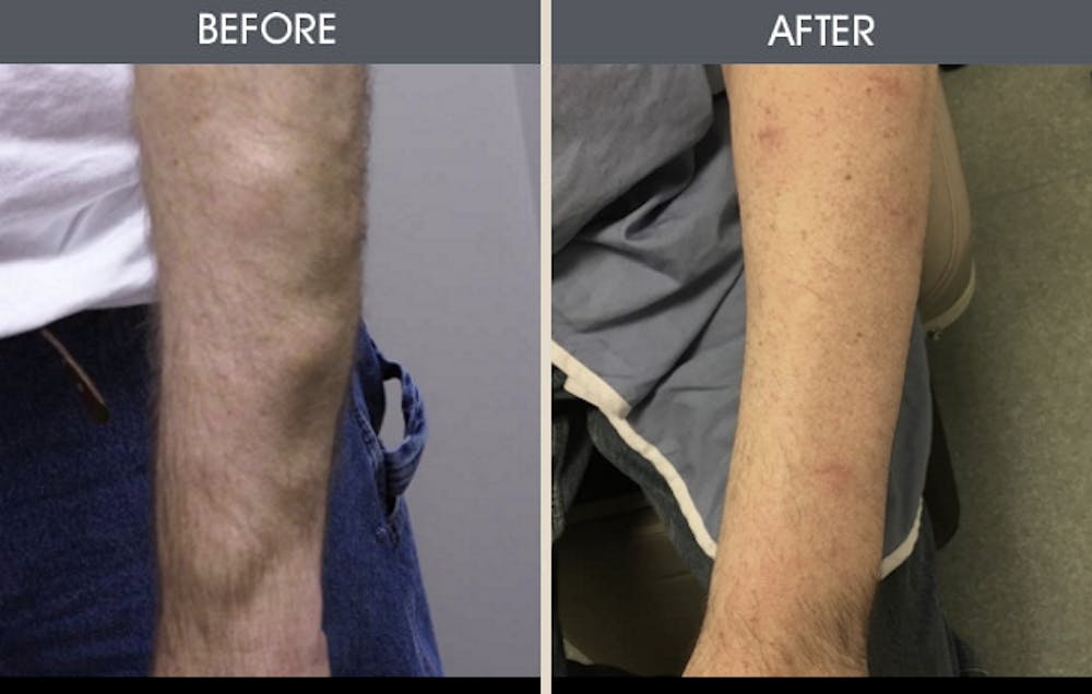 Lipoma Removal Before & After Gallery - Patient 2207490 - Image 1