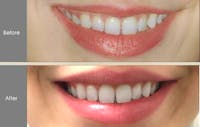 Lip Fillers Before & After Gallery - Patient 149147499 - Image 1