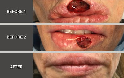 Skin Cancer Reconstruction Gallery Before & After Gallery - Patient 2207509 - Image 1