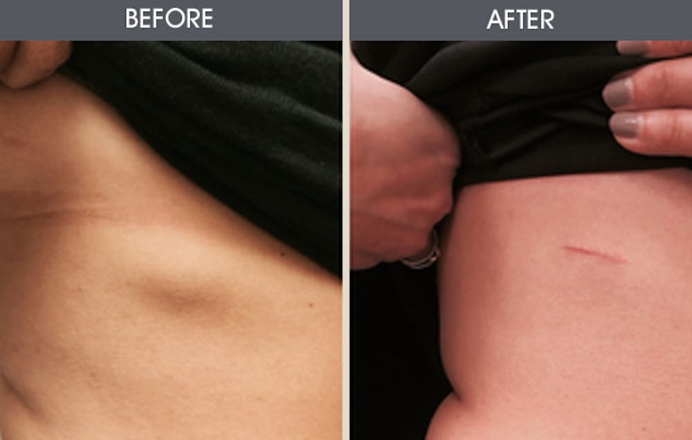 Lipoma Removal Before & After Gallery - Patient 2207510 - Image 1