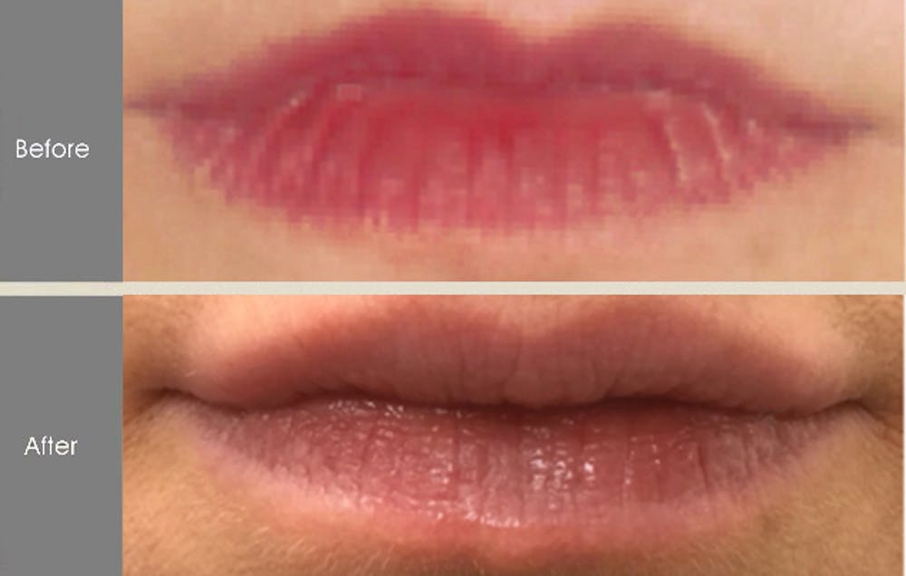 Lip Fillers Before & After Gallery - Patient 149147498 - Image 1