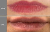 Lip Fillers Gallery Before & After Gallery - Patient 149147498 - Image 1