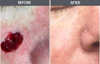Skin Cancer Reconstruction Before & After Gallery - Patient 2207523 - Image 1