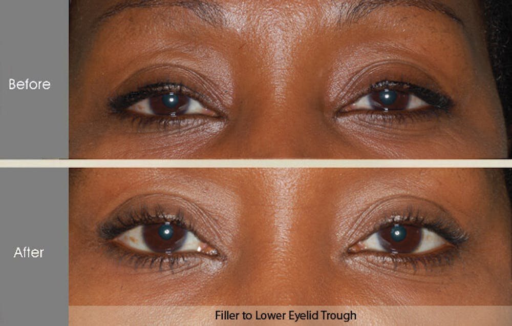 Fillers Before & After Gallery - Patient 2207528 - Image 1