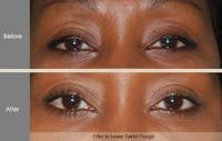 Fillers Before & After Gallery - Patient 2207528 - Image 1