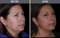 Facial Fat Transfer Gallery Before & After Gallery - Patient 2207539 - Image 1