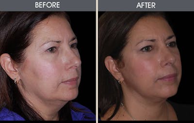 Facial Fat Transfer Before & After Gallery - Patient 2207539 - Image 1