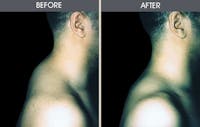 Lipoma Removal Before & After Gallery - Patient 2207544 - Image 1