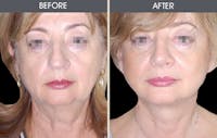 Facial Fat Transfer Before & After Gallery - Patient 2207556 - Image 1