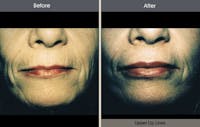 Chemical Peel Before & After Gallery - Patient 2207565 - Image 1