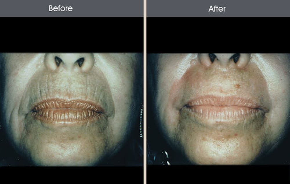 Chemical Peel Gallery Before & After Gallery - Patient 2207586 - Image 1