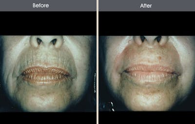 Chemical Peel Before & After Gallery - Patient 2207586 - Image 1