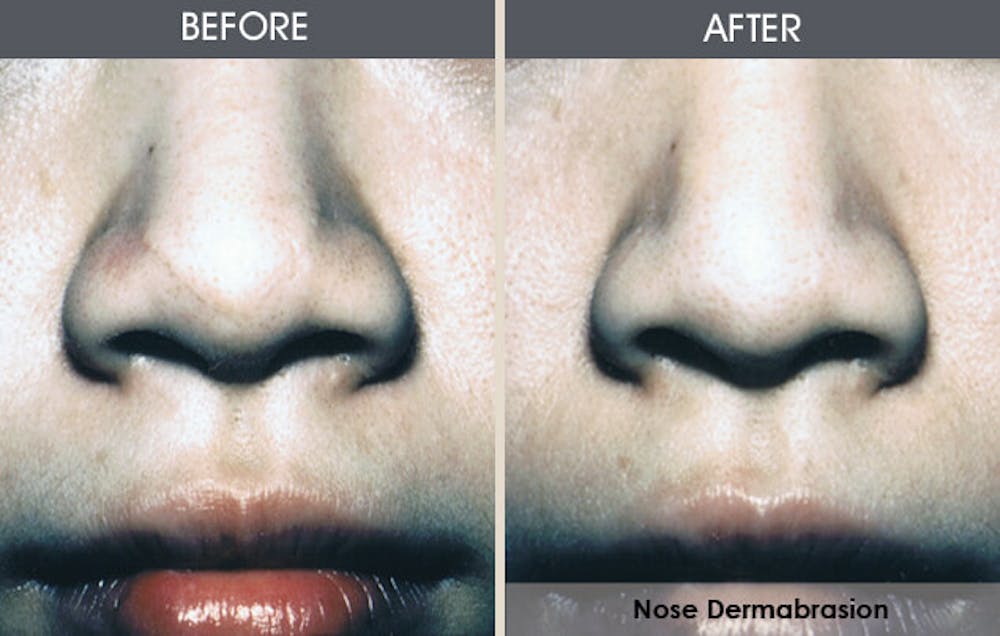Dermabrasion Before & After Gallery - Patient 2207610 - Image 1