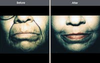Chemical Peel Gallery Before & After Gallery - Patient 2207609 - Image 1