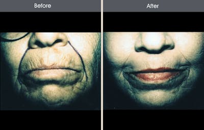 Chemical Peel Gallery Before & After Gallery - Patient 2207609 - Image 1