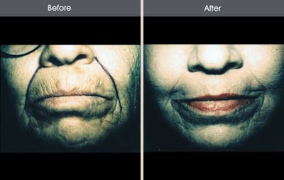 Chemical Peel Gallery - Patient 2207609 - Image 1