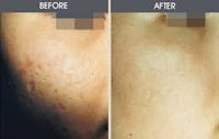 Dermabrasion Gallery Before & After Gallery - Patient 2207623 - Image 1