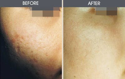 Dermabrasion Gallery Before & After Gallery - Patient 2207623 - Image 1