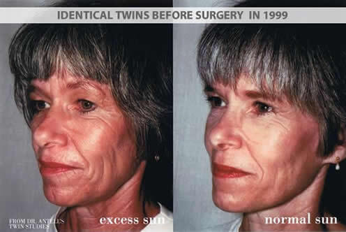 Identical Twins Before Surgery