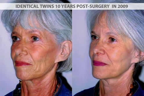 Identical Twins After Surgery