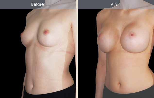 Breast augmentation before and after